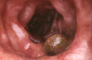 cancer de colon